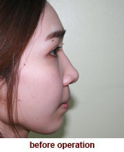 plastic_surgery_augmentation_rhinoplasty